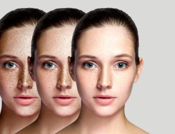 เข้าใจ ‘ฝ้า’ ให้ชัด สาเหตุที่เกิดมาจากอะไร ? “กิฟฟารีน” ทวงคืนผิวสวย จบปัญหากวนใจ